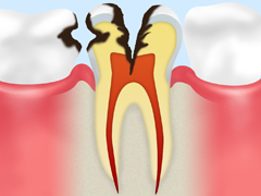 歯の神経におよんだ虫歯