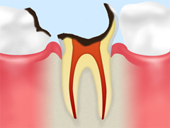 歯根におよんだ虫歯