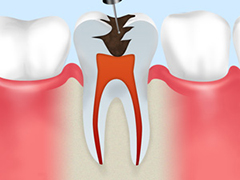 歯の神経除去