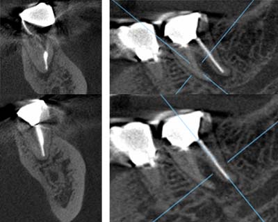 CT撮影による3D診断