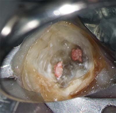 クラウン（金歯）と充填物除去後