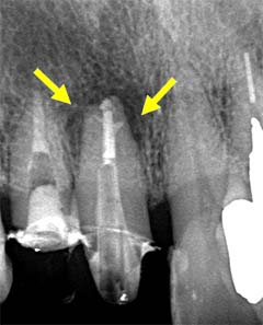 側枝（細い枝のように伸びるサブ根管）