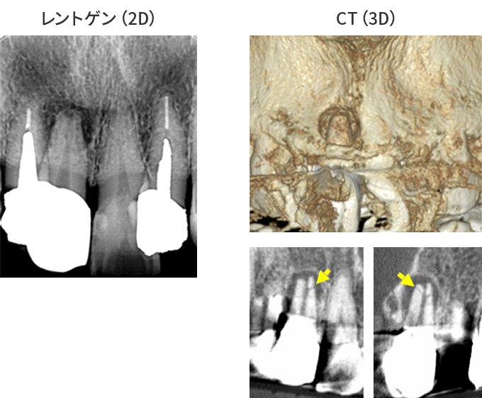レントゲン(2D) vs CT(3D)