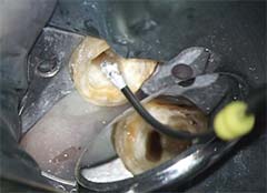 根の先端（アペックス）に薬を詰める工程