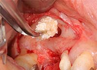 AFG（Autologous Fibrin Glue）