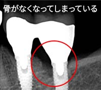 インプラント周囲炎