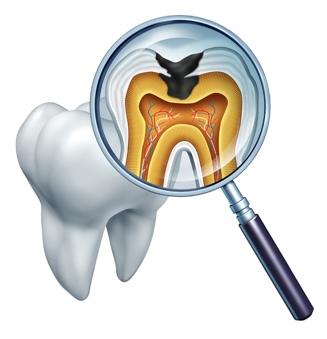 虫歯は早期発見・早期治療を