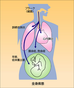 歯周病が全身におよぼす影響